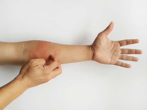 Güneş Alerjisi Nedir? Belirtileri ve Dikkat Edilmesi Gereken Noktalar