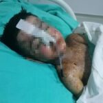 salatalik yutunca rahatsizlandi 3 yil once vucudunda 18 santimlik kateter unutuldugu ortaya cikti 21ded4042772