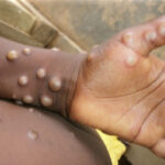 ganada maymun cicegi virusu vaka sayisi 583e yukseldi faf054a66a92