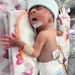 600 gram dogan ve 98 gun tedavi goren asil bebek 2 yasinda c477bb546485