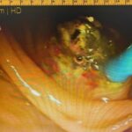 ic organlari ters yonde olan hasta ercp yontemiyle sagligina kavustu 0fe5eda256c2