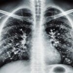 İzmir'de Prof. Dr. Alper Şener'den grip sonrası bakteriyel enfeksiyonlara dikkat uyarısı 1 prof dr senerden superenfeksiyon uyarisi dikkat etmek lazim ucretsiz asinizi olun dde9be403e42