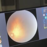 rizede premature retinopatisi tani ve tedavisi yapilabilecek 867aeeb30e15