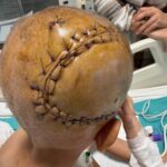 Batman'da 7 Yaşındaki Eyüp Ensar Işık, Ameliyatla Beyin Tümöründen Kurtuldu 9 beyninde tumor olan 7 yasindaki eyup ensar 5 saatlik ameliyatla sagligina kavustu 0120f636eb41