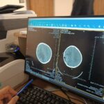 Batman'da 7 Yaşındaki Eyüp Ensar Işık, Ameliyatla Beyin Tümöründen Kurtuldu 7 beyninde tumor olan 7 yasindaki eyup ensar 5 saatlik ameliyatla sagligina kavustu 3c35ee0d4ce4