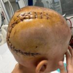 Batman'da 7 Yaşındaki Eyüp Ensar Işık, Ameliyatla Beyin Tümöründen Kurtuldu 8 beyninde tumor olan 7 yasindaki eyup ensar 5 saatlik ameliyatla sagligina kavustu fe55f999cd2f