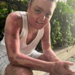 Kağıthane'de Kuaförde Yangın, Genç Çocuk Ağır Yaralandı ve Yeniden Hayata Döndü 5 istanbul kagithanede kuafordeki yanginda vucudu yanan 15 yasindaki engin mucadeleyi kesinlikle birakmasinlar ben yilmadim ab1fc7cb412a