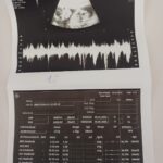 istanbul 55 aylik hamile nazirenin beyninden 7 santimetrelik tumor cikarildi e409bcef03d4