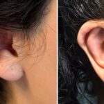 kepce kulak ameliyati ozguveni artiriyor e0a05c0b066e