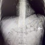 mide ve bagirsaklarindan 91 kapsul metamfetamin cikan 2 supheli tutuklandi 771746cabb55