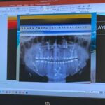 'Ortognatik cerrahi ile hastalar hem çiğneme fonksiyonuna hem de estetik görünüme kavuşuyor' 2 ortognatik cerrahi ile hastalar hem cigneme fonksiyonuna hem de estetik gorunume kavusuyor 75d62dd5b6a2