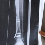 arkeolojik kazi alanindaki cukura dusunce ayaginda yuzde 3luk engel olustu 1 milyon lira tazminat karari cikti 8bc3cd6a5690